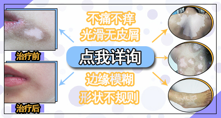 颈部白癜风早期治疗的注意事项有哪些呢